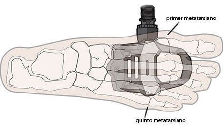 Metatarsos 1 y 5